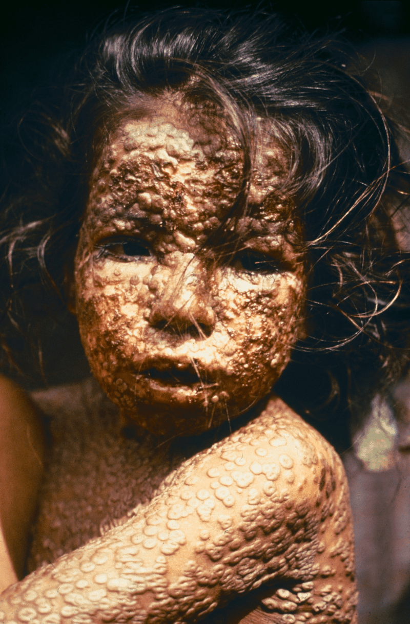 Niña infectada por viruela en Bangladesh en 1973
